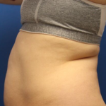 CoolSculpting Elite Before & After Patient #14214