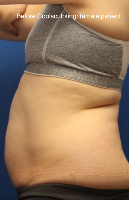 CoolSculpting Elite Before & After Patient #14214