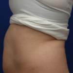 CoolSculpting Elite Before & After Patient #14214