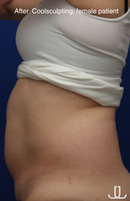 CoolSculpting Elite Before & After Patient #14214
