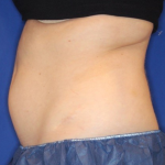 CoolSculpting Elite Before & After Patient #15810