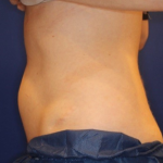 CoolSculpting Elite Before & After Patient #15810