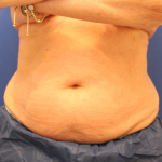 CoolSculpting Elite Before & After Patient #14207