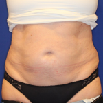 CoolSculpting Elite Before & After Patient #14207