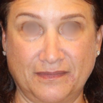Emface Before & After Patient #13906