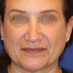 Emface Before & After Patient #13906