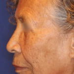 Emface Before & After Patient #13905