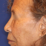 Emface Before & After Patient #13905