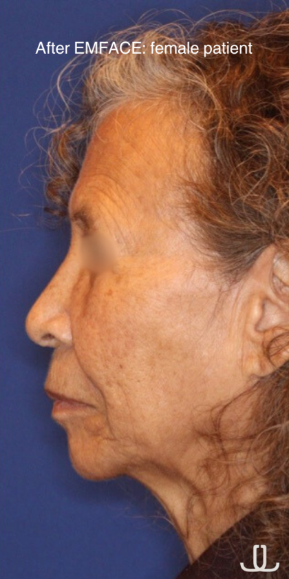 Emface Before & After Patient #13905