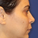 Emface Before & After Patient #13904