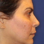 Emface Before & After Patient #13904