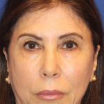 Emface Before & After Patient #13902