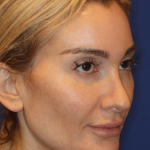 Emface Before & After Patient #13903
