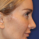 Emface Before & After Patient #13903
