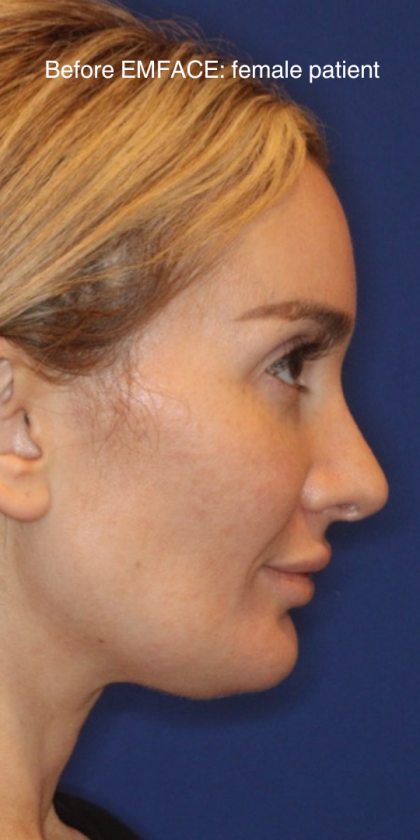 Emface Before & After Patient #13903