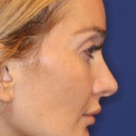 Emface Before & After Patient #13903