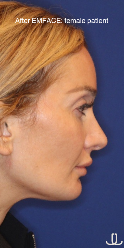 Emface Before & After Patient #13903