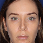 Emface Before & After Patient #15035