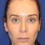 Emface Before & After Patient #15035