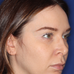 Emface Before & After Patient #15035