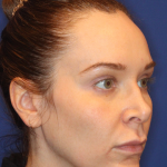 Emface Before & After Patient #15035