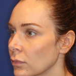 Emface Before & After Patient #15035