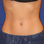 Emsculpt NEO Before & After Patient #15382