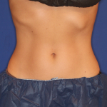 Emsculpt NEO Before & After Patient #15382
