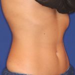 Emsculpt NEO Before & After Patient #15382