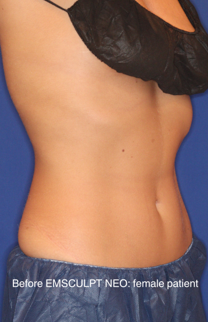 Emsculpt NEO Before & After Patient #15382
