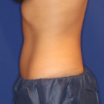 Emsculpt NEO Before & After Patient #15382