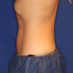 Emsculpt NEO Before & After Patient #15382