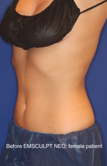 Emsculpt NEO Before & After Patient #15382