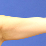 Emsculpt NEO Before & After Patient #14248