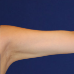 Emsculpt NEO Before & After Patient #14248