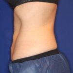 Emsculpt NEO Before & After Patient #15381