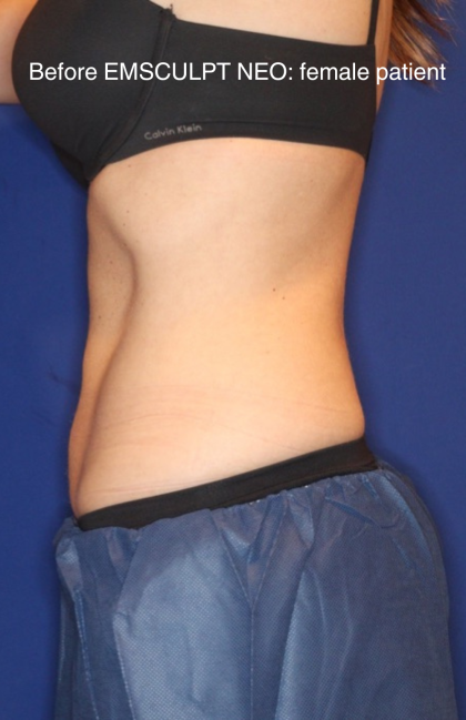 Emsculpt NEO Before & After Patient #15381