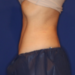 Emsculpt NEO Before & After Patient #15381