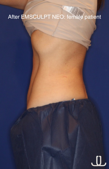 Emsculpt NEO Before & After Patient #15381