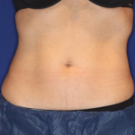 Emsculpt NEO Before & After Patient #15381