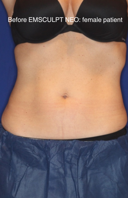 Emsculpt NEO Before & After Patient #15381