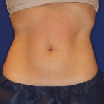 Emsculpt NEO Before & After Patient #15381