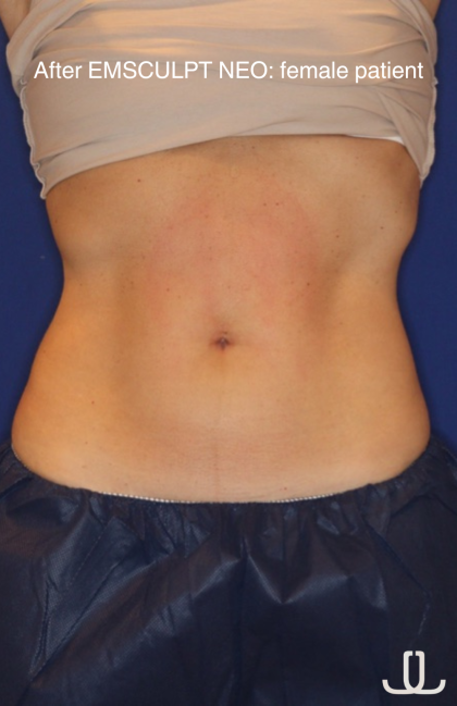 Emsculpt NEO Before & After Patient #15381