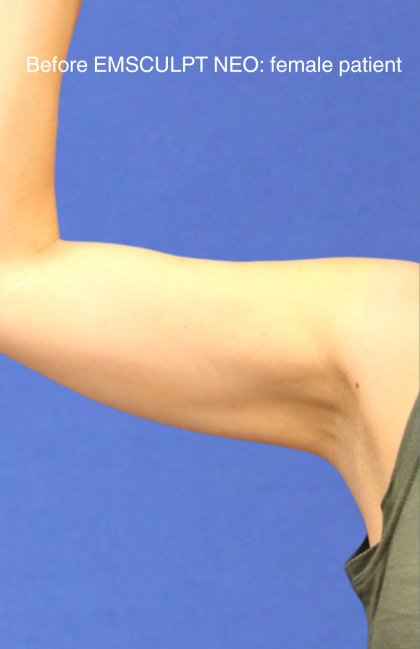 Emsculpt NEO Before & After Patient #14248