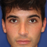 Evoke Before & After Patient #15738
