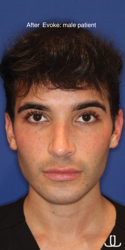 Evoke Before & After Patient #15738