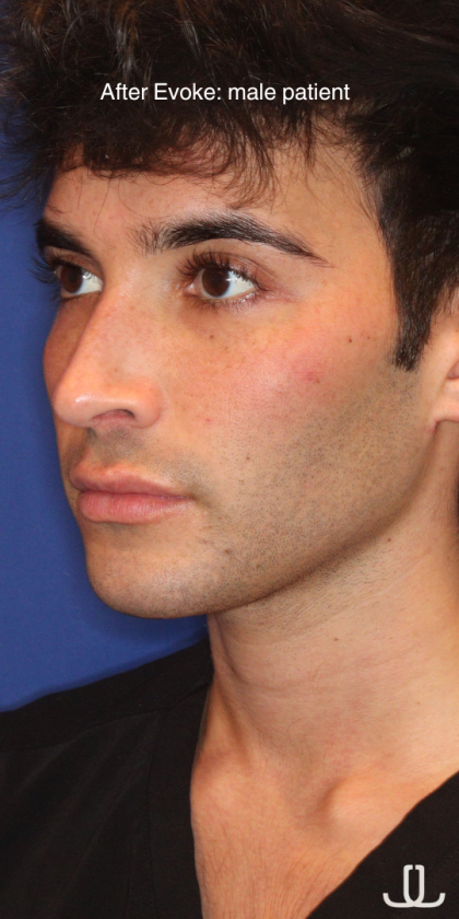 Evoke Before & After Patient #15738