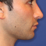 Evoke Before & After Patient #15738