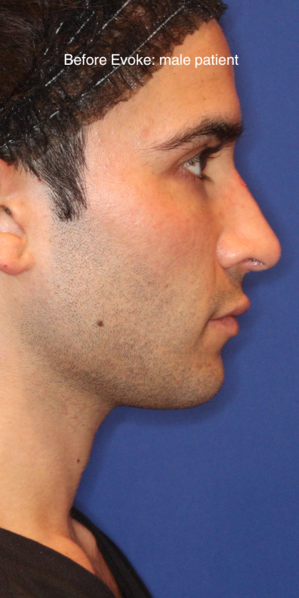 Evoke Before & After Patient #15738