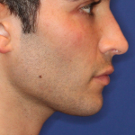 Evoke Before & After Patient #15738
